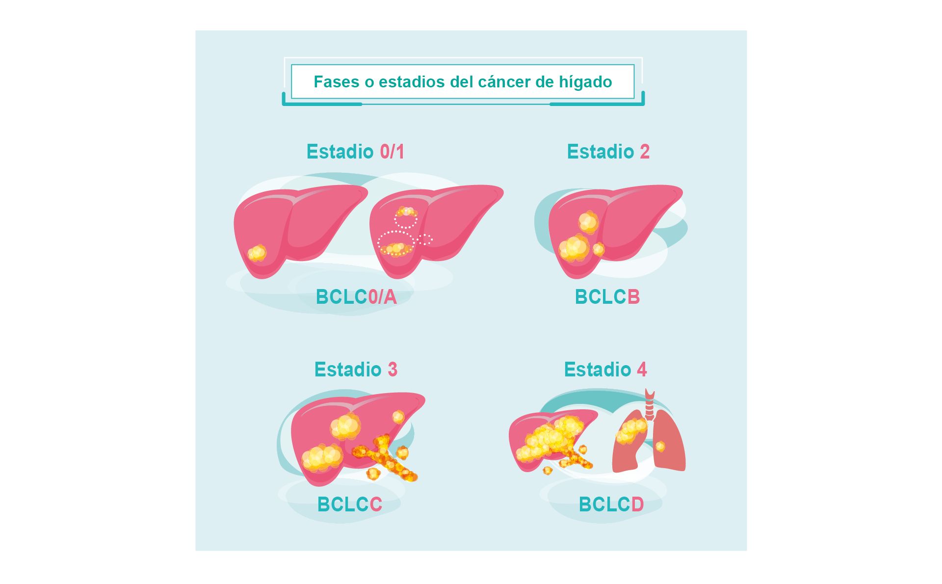 Fases O Estadios Del Cáncer De Hígado Roche Pacientes 9211